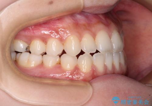 舌突出癖で口元が開いてしまう 舌トレーニングを行ったインビザライン矯正の治療中