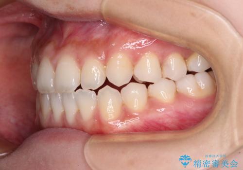 舌突出癖で口元が開いてしまう 舌トレーニングを行ったインビザライン矯正の治療中