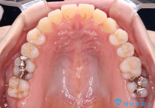 舌突出癖で口元が開いてしまう 舌トレーニングを行ったインビザライン矯正の治療中