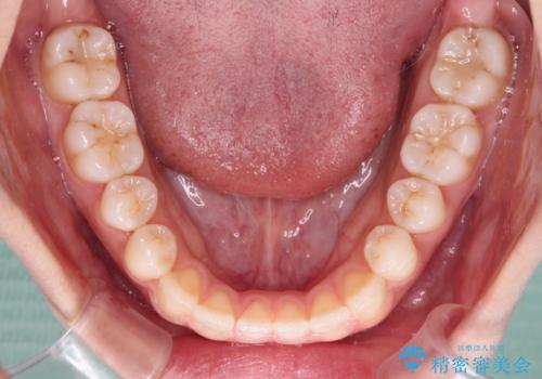 舌突出癖で口元が開いてしまう 舌トレーニングを行ったインビザライン矯正の治療中