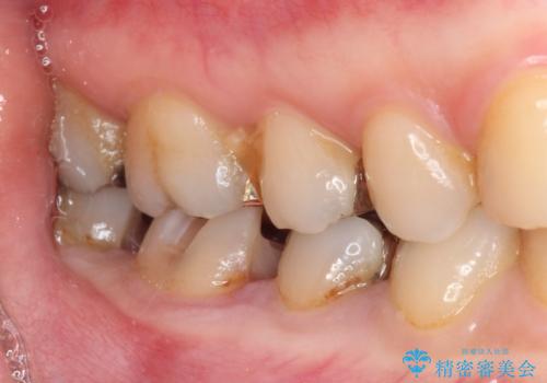 下の奥歯の虫歯をゴールドインレーで治療の治療中