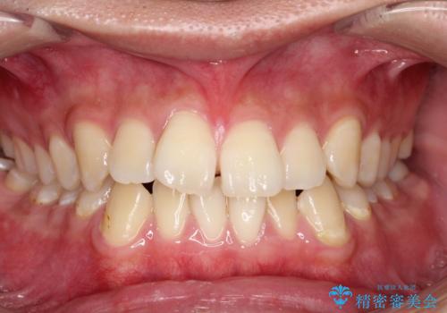 【ワイヤー矯正】前歯の凸凹を治したい。の症例 治療前