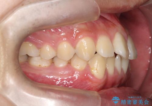 【ワイヤー矯正】前歯の凸凹を治したい。の治療前