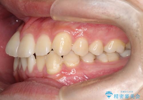 【ワイヤー矯正】前歯の凸凹を治したい。の治療前