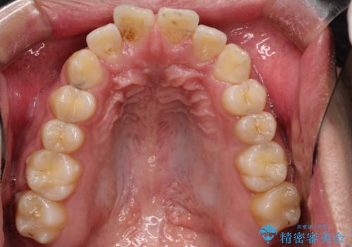 【ワイヤー矯正】前歯の凸凹を治したい。の治療前