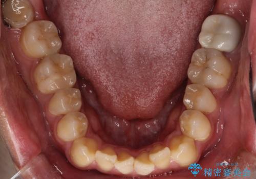 【ワイヤー矯正】前歯の凸凹を治したい。の治療前