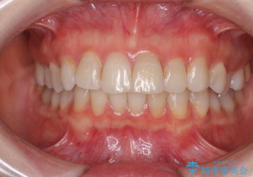 前歯の突出感とデコボコをインビザライン矯正で改善の症例 治療前
