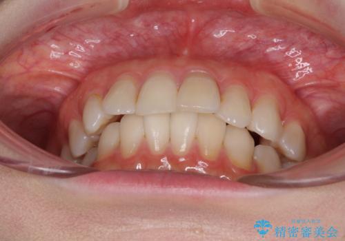 前歯の突出感とデコボコをインビザライン矯正で改善の治療前