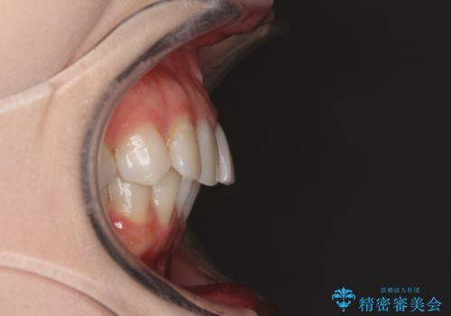 前歯の突出感とデコボコをインビザライン矯正で改善の治療前