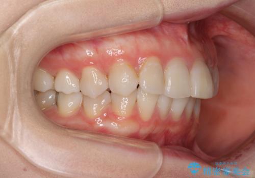 前歯の突出感とデコボコをインビザライン矯正で改善の治療前