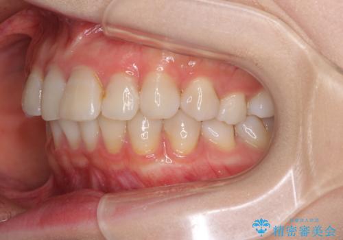 前歯の突出感とデコボコをインビザライン矯正で改善の治療前