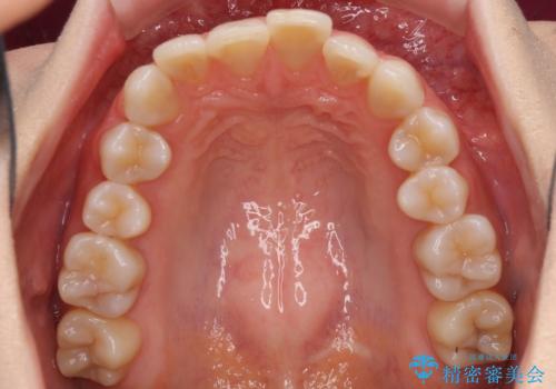 前歯の突出感とデコボコをインビザライン矯正で改善の治療前