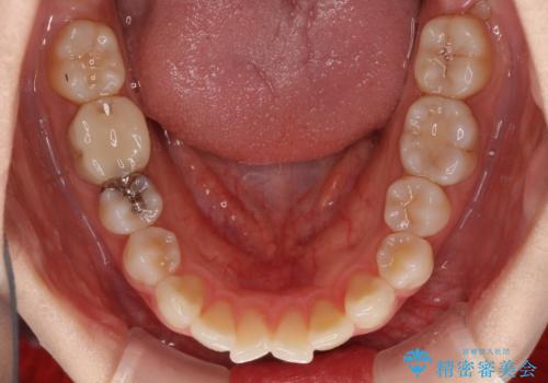 前歯の突出感とデコボコをインビザライン矯正で改善の治療前