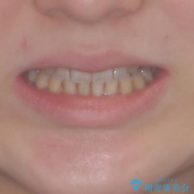オープンバイトと前歯のデコボコをインビザライン矯正で解消の治療後（顔貌）