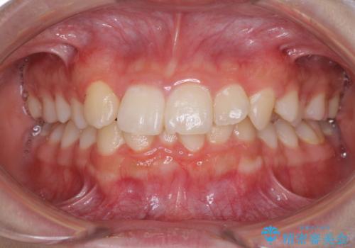 インビザラインが続けられない　ワイヤー矯正での抜歯矯正　その2の症例 治療前