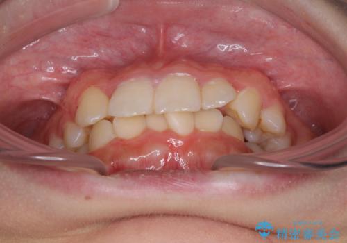 インビザラインが続けられない ワイヤー矯正での抜歯矯正 その2の治療前