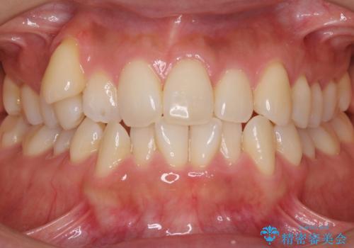 八重歯　上下の正中のずれ　40代で抜歯矯正の症例 治療前