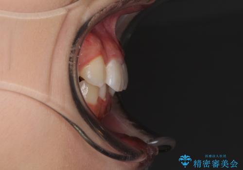 インビザラインが続けられない ワイヤー矯正での抜歯矯正 その2の治療前