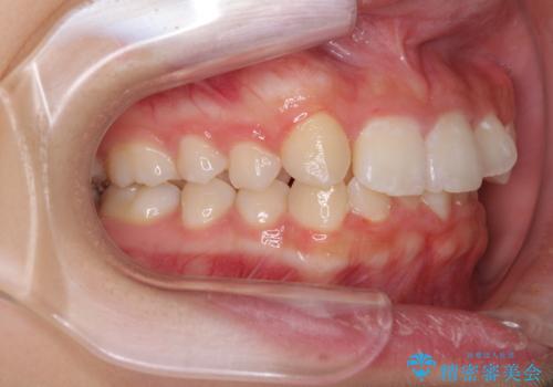 インビザラインが続けられない ワイヤー矯正での抜歯矯正 その2の治療前