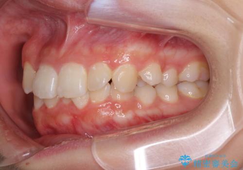 インビザラインが続けられない　ワイヤー矯正での抜歯矯正　その2の治療前