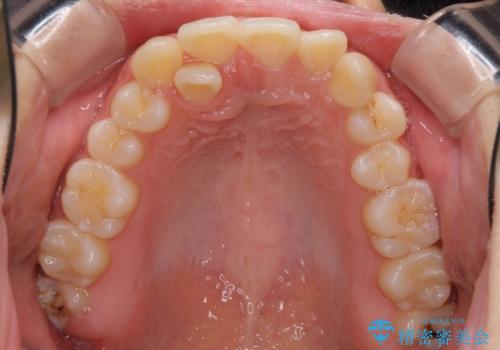 インビザラインが続けられない ワイヤー矯正での抜歯矯正 その2の治療前