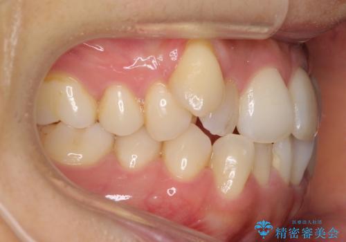 八重歯　上下の正中のずれ　40代で抜歯矯正の治療前
