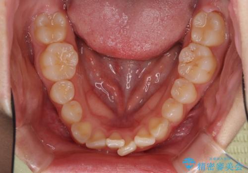 インビザラインが続けられない ワイヤー矯正での抜歯矯正 その2の治療前