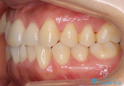 八重歯 上下の正中のずれ 40代で抜歯矯正の治療前