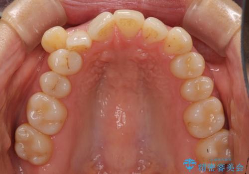 八重歯 上下の正中のずれ 40代で抜歯矯正の治療前