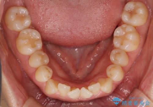 八重歯　上下の正中のずれ　40代で抜歯矯正の治療前