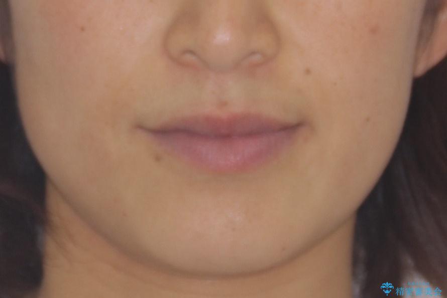 八重歯 上下の正中のずれ 40代で抜歯矯正の治療前(顔貌)