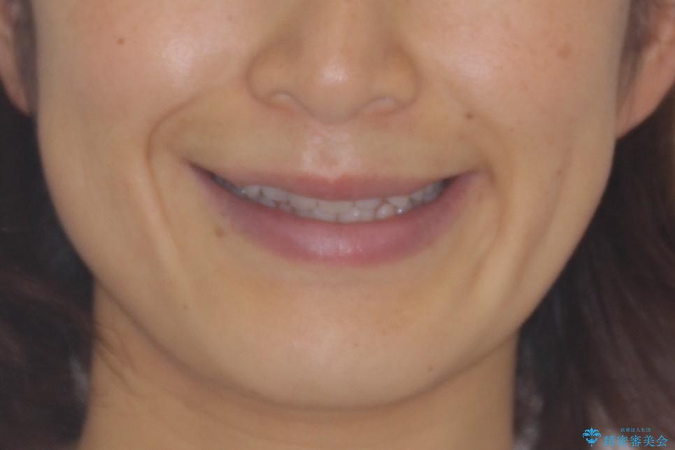 八重歯 上下の正中のずれ 40代で抜歯矯正の治療前(顔貌)