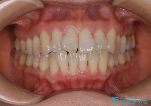 歯ぐき、骨が薄い方のマウスピース矯正治療　非抜歯でもIPR(歯を削る処置)で口元に変化をの症例 治療前