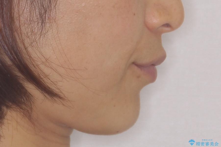 八重歯 上下の正中のずれ 40代で抜歯矯正の治療前(顔貌)