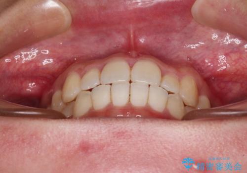 すきっ歯とオープンバイトをインビザラインで改善の治療中