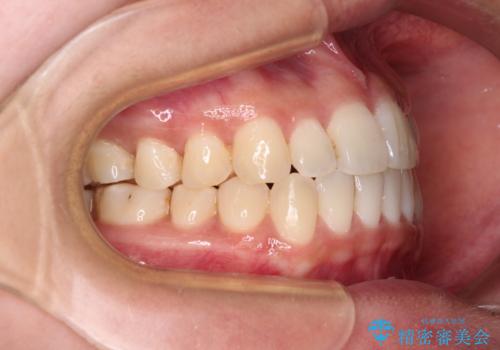 すきっ歯とオープンバイトをインビザラインで改善の治療中