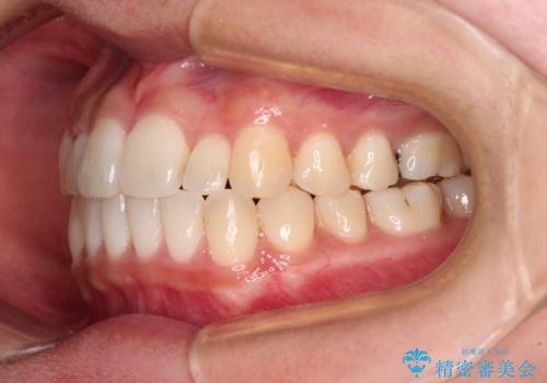 すきっ歯とオープンバイトをインビザラインで改善の治療中