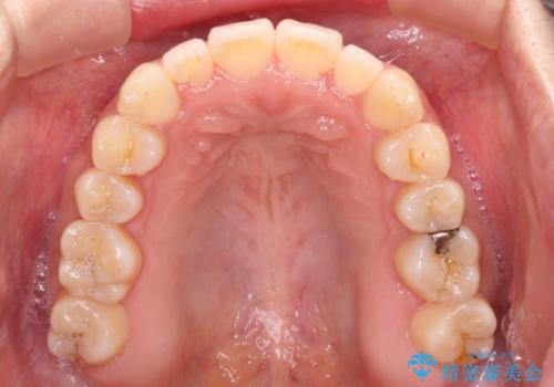 すきっ歯とオープンバイトをインビザラインで改善の治療中