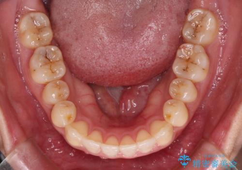 すきっ歯とオープンバイトをインビザラインで改善の治療中