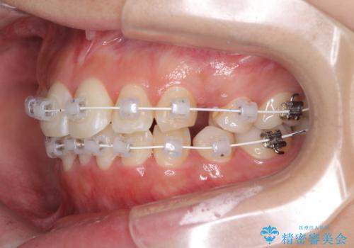 インビザラインが続けられない　ワイヤー矯正での抜歯矯正　その1の治療中