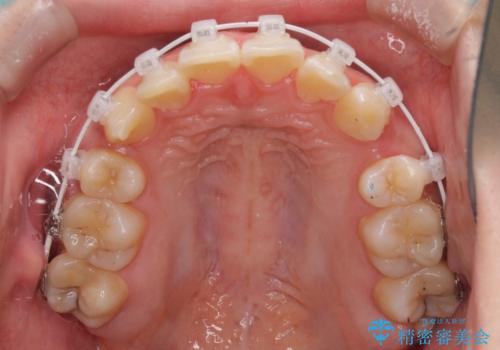 インビザラインが続けられない　ワイヤー矯正での抜歯矯正　その1の治療中