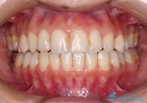 オープンバイトによる見た目を治したい インビザラインでの矯正治療の治療中