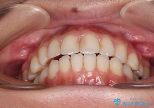 オープンバイトによる見た目を治したい インビザラインでの矯正治療の治療中
