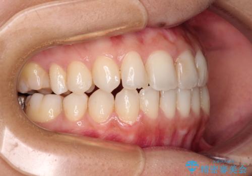 オープンバイトによる見た目を治したい インビザラインでの矯正治療の治療中