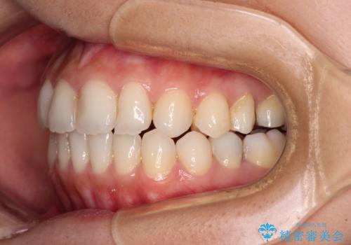 オープンバイトによる見た目を治したい インビザラインでの矯正治療の治療中