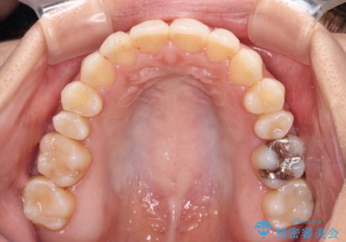 オープンバイトによる見た目を治したい インビザラインでの矯正治療の治療中
