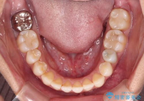 オープンバイトによる見た目を治したい インビザラインでの矯正治療の治療中