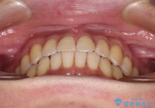 リスク回避 ワイヤー矯正を併用したインビザライン矯正治療の治療中