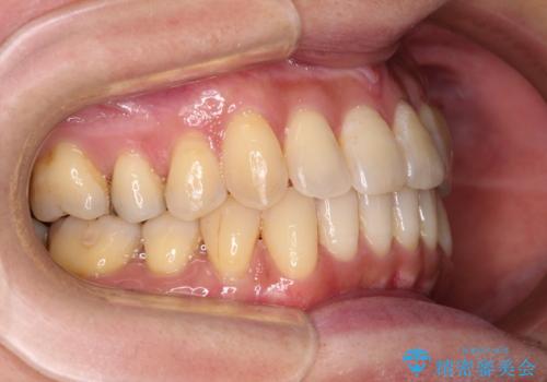 リスク回避 ワイヤー矯正を併用したインビザライン矯正治療の治療中