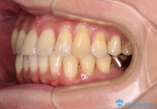 リスク回避 ワイヤー矯正を併用したインビザライン矯正治療の治療中